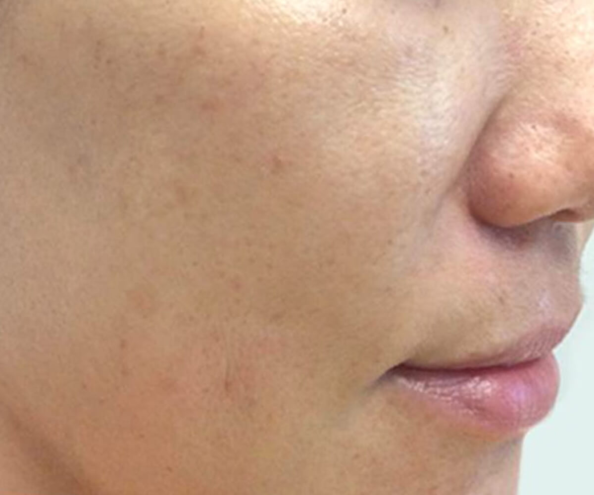 After 60 days using OM Botanical Vitamin C Serum — brighter, firmer skin with reduced dark spots