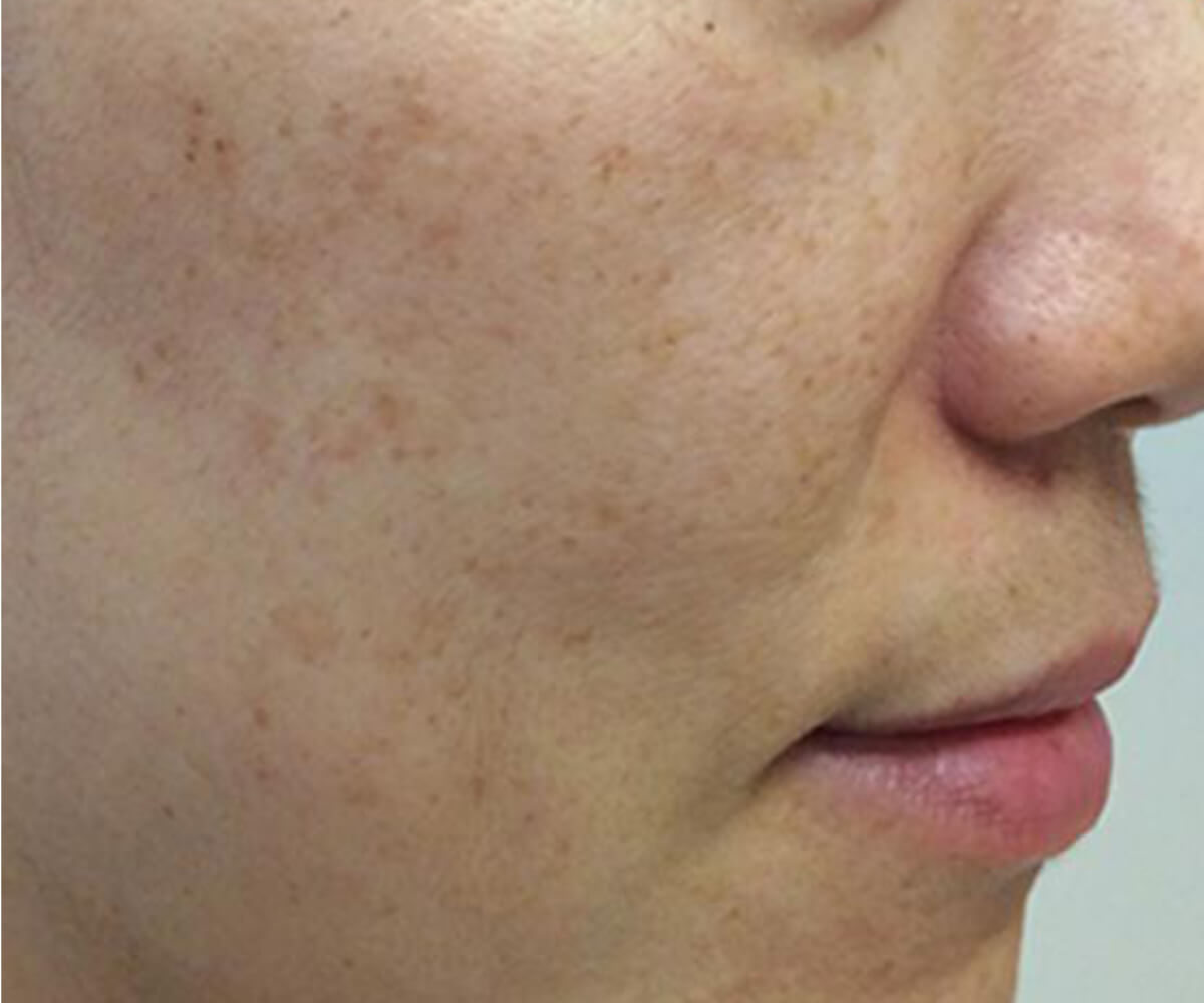 Before using OM Botanical Vitamin C Serum — uneven skin tone with visible dark spots