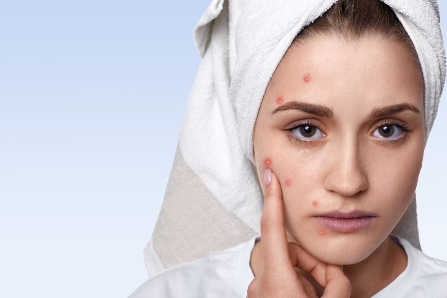 Woman with acne