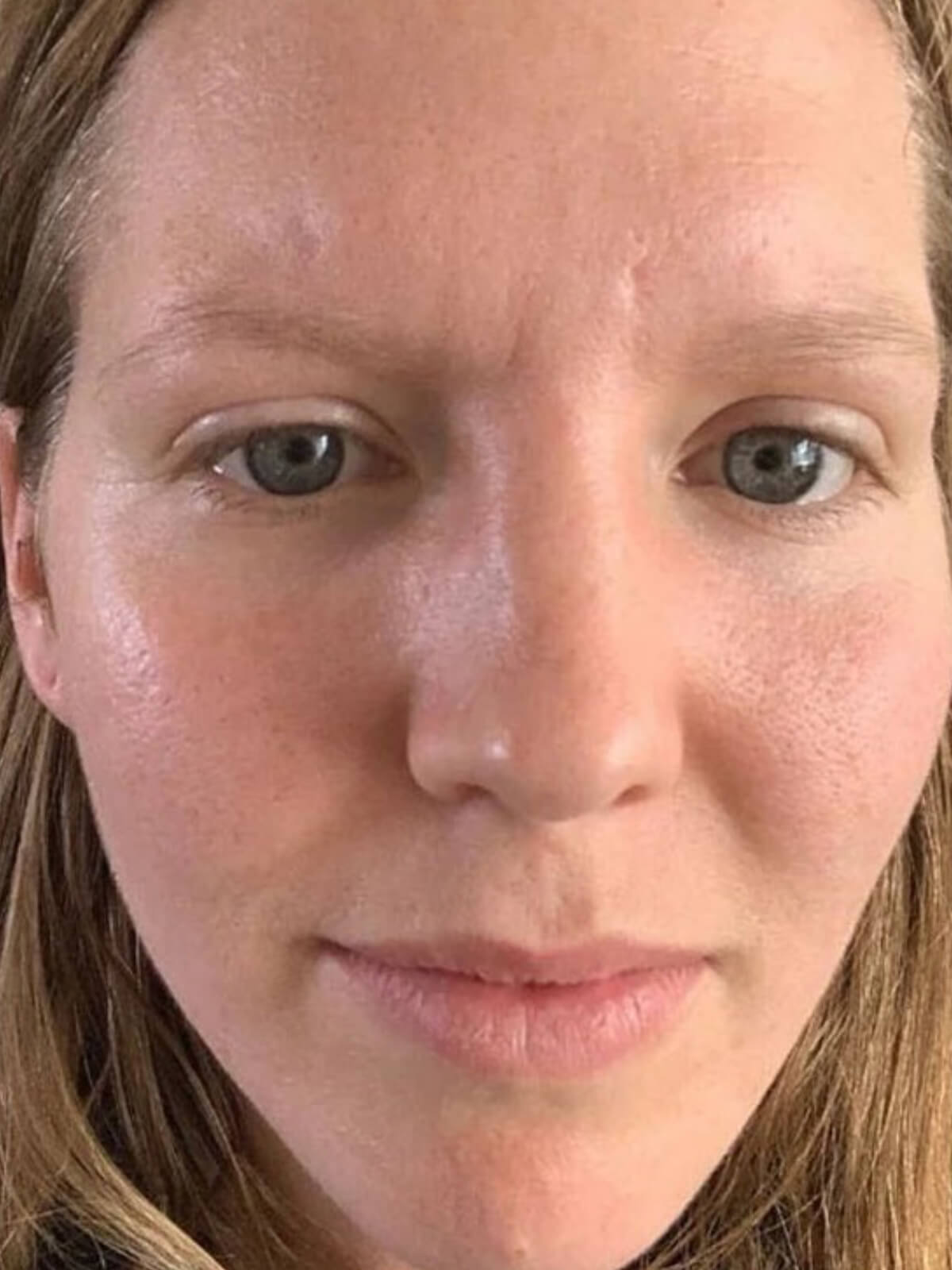 Before using OM Botanical Bakuchiol Serum — fine lines and uneven skin texture