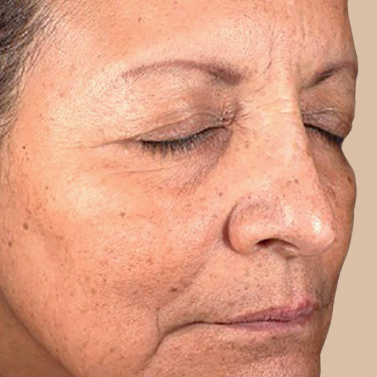After 7 days using OM Botanical Vitamin B3 Serum — calmer skin with reduced redness and more even tone