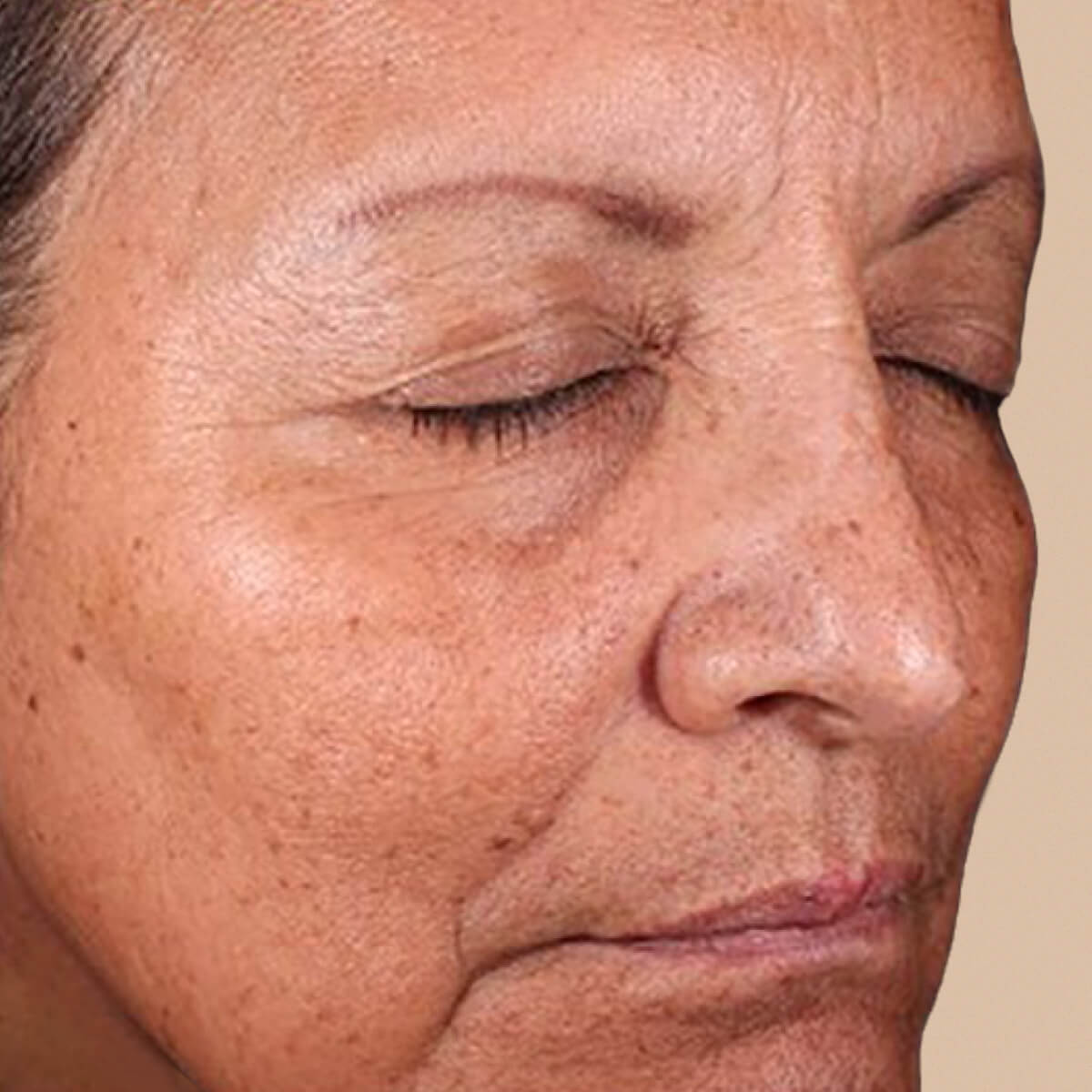 Before using OM Botanical Vitamin B3 Serum — redness and uneven skin tone